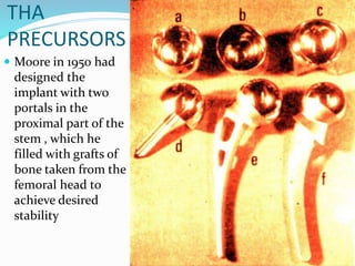 THA
PRECURSORS
 Moore in 1950 had
designed the
implant with two
portals in the
proximal part of the
stem , which he
filled with grafts of
bone taken from the
femoral head to
achieve desired
stability
 