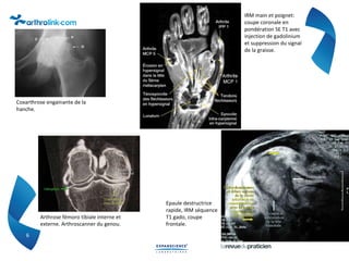 6
Coxarthrose engainante de la
hanche.
IRM main et poignet:
coupe coronale en
pondération SE T1 avec
injection de gadolini...