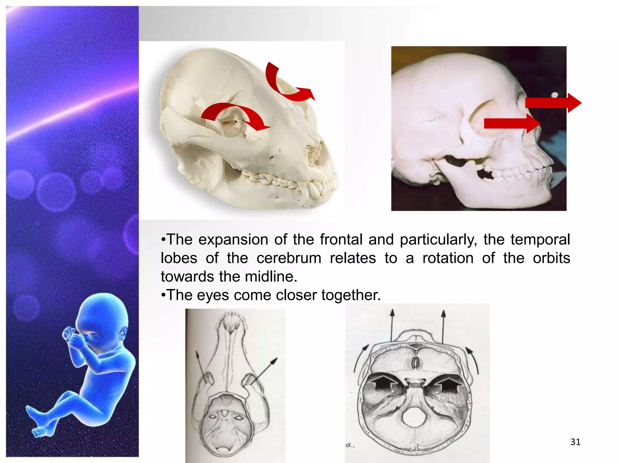 31The expansion of the frontal and particularly, the temporal lobes of the cerebrum relates to a rotation of the orbits towards the midline.