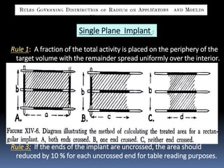 Single Plane Implant :
Rule 1: A fraction of the total activity is placed on the periphery of the
target volume with the remainder spread uniformly over the interior.
Implant Area Fraction on Periphery
< 25 cm2
2/3
25 – 100
1/2
> 100
1/3
Rule 2: The needles should be arranged in parallel rows 1 cm apart
with the ends crossed.
Rule 3: If the ends of the implant are uncrossed, the area should
reduced by 10 % for each uncrossed end for table reading purposes.

 
