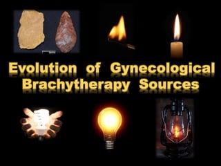 Evolution of Gynecological
Brachytherapy Sources

 