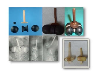 Loose preloaded
system with
chances of slipping
of ovoids and hence
disturbed geometry
and creation of cold
and hot spots
leading to high
failure or increased
morbidity.

 