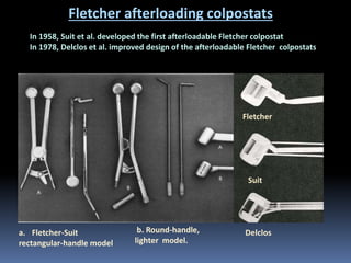 Fletcher afterloading colpostats
In 1958, Suit et al. developed the first afterloadable Fletcher colpostat
In 1978, Delclos et al. improved design of the afterloadable Fletcher colpostats

Fletcher

Suit

a. Fletcher-Suit
rectangular-handle model

b. Round-handle,
lighter model.

Delclos

 