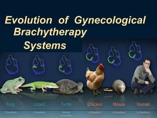 Evolution of Gynecological
Brachytherapy
Systems

 