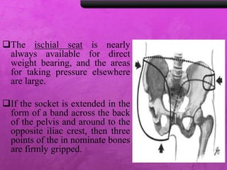 The ischial seat is nearly
always available for direct
weight bearing, and the areas
for taking pressure elsewhere
are large.
If the socket is extended in the
form of a band across the back
of the pelvis and around to the
opposite iliac crest, then three
points of the in nominate bones
are firmly gripped.
 