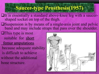 Saucer-type Prosthesis(1957)
It is essentially a standard above-knee leg with a saucer-
shaped socket on top of the thigh.
Suspension is by means of a single-axis joint and pelvic
band and may include straps that pass over the shoulder.
This type is most
suitable for short
femur amputations
because adequate stability
is difficult to achieve
without the additional
bone structure.
 