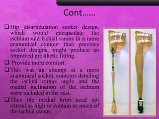Cont……
Hip disarticulation socket design,
which would encapsulate the
ischium and ischial ramus in a more
anatomical contour than previous
socket designs, might produce an
improved prosthetic fitting.
 Provide more comfort.
This was an attempt at a more
anatomical socket, contours detailing
the ischial ramus angle and the
medial inclination of the ischium
were included in the cast.
Thus the medial brim need not
extend as high or contain as much of
the ischial ramus.
 