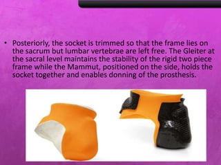 • Posteriorly, the socket is trimmed so that the frame lies on
the sacrum but lumbar vertebrae are left free. The Gleiter at
the sacral level maintains the stability of the rigid two piece
frame while the Mammut, positioned on the side, holds the
socket together and enables donning of the prosthesis.
 