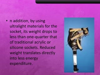 • n addition, by using
ultralight materials for the
socket, its weight drops to
less than one-quarter that
of traditional acrylic or
silicone sockets. Reduced
weight translates directly
into less energy
expenditure.
 