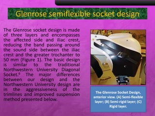 Glenrose semiflexible socket design
The Glenrose socket design is made
of three layers and encompasses
the affected side and iliac crest,
reducing the band passing around
the sound side between the iliac
crest and the greater trochanter to
50 mm (Figure 1). The basic design
is similar to the traditional
Northwestern University Diagonal
Socket.6 The major differences
between our design and the
Northwestern University design are
in the aggressiveness of the
trimlines and improved suspension
method presented below.
The Glenrose Socket Design,
anterior view. (A) Semi-flexible
layer; (B) Semi-rigid layer; (C)
Rigid layer.
 