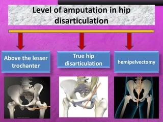 Level of amputation in hip
disarticulation
Above the lesser
trochanter
True hip
disarticulation hemipelvectomy
 