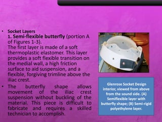 • Socket Layers
1. Semi-flexible butterfly (portion A
of Figures 1-3).
The first layer is made of a soft
thermoplastic elastomer. This layer
provides a soft flexible transition on
the medial wall, a high friction
surface to aid suspension, and a
flexible, forgiving trimline above the
iliac crest.
• The butterfly shape allows
movement of the iliac crest
suspension without buckling of the
material. This piece is difficult to
fabricate and requires a skilled
technician to accomplish.
Glenrose Socket Design
interior, viewed from above
from the sound side. (A)
Semiflexible layer with
butterfly shape; (B) Semi-rigid
polyethylene layer.
 