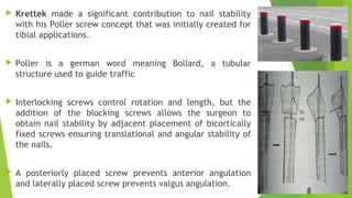  Krettek made a significant contribution to nail stability
with his Poller screw concept that was initially created for
tibial applications.
 Poller is a german word meaning Bollard, a tubular
structure used to guide traffic
 Interlocking screws control rotation and length, but the
addition of the blocking screws allows the surgeon to
obtain nail stability by adjacent placement of bicortically
fixed screws ensuring translational and angular stability of
the nails.
 A posteriorly placed screw prevents anterior angulation
and laterally placed screw prevents valgus angulation.
 