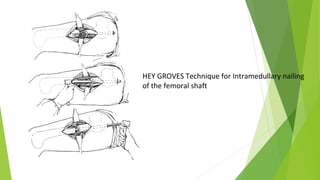 HEY GROVES Technique for Intramedullary nailing
of the femoral shaft
 
