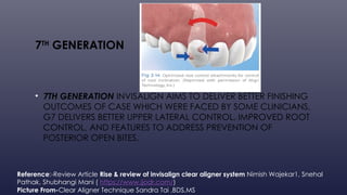 Evolution of Invisalign By-Dr.Chirag Ahuja | PPTX