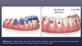 Evolution of Invisalign By-Dr.Chirag Ahuja | PPTX