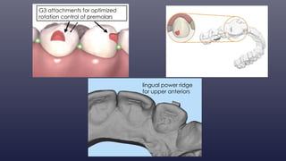 Power Ridge Unvisalign Evolution of Invisalign By-Dr.Chirag Ahuja | PPTX