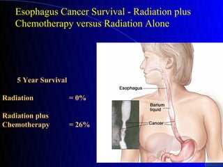 Esophagus Cancer Survival - Radiation plus
   Chemotherapy versus Radiation Alone




    5 Year Survival

Radiation             = 0%

Radiation plus
Chemotherapy          = 26%
 