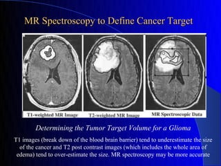 MR Spectroscopy to Define Cancer Target




        Determining the Tumor Target Volume for a Glioma
T1 images (break down of the blood brain barrier) tend to underestimate the size
  of the cancer and T2 post contrast images (which includes the whole area of
 edema) tend to over-estimate the size. MR spectroscopy may be more accurate
 