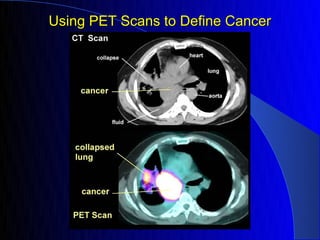 Using PET Scans to Define Cancer
 