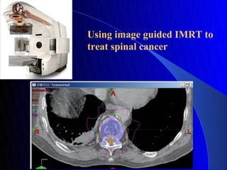 Using image guided IMRT to
treat spinal cancer
 