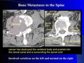 Bone Metastases to the Spine




Involved vertebrae on the left and normal on the right
 