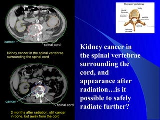 Kidney cancer in
the spinal vertebrae
surrounding the
cord, and
appearance after
radiation…is it
possible to safely
radiate further?
 
