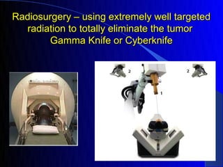 Radiosurgery – using extremely well targeted
  radiation to totally eliminate the tumor
       Gamma Knife or Cyberknife
 