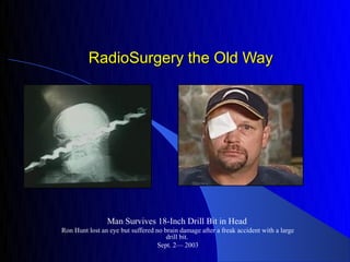 RadioSurgery the Old Way




                Man Survives 18-Inch Drill Bit in Head
Ron Hunt lost an eye but suffered no brain damage after a freak accident with a large
                                      drill bit.
                                   Sept. 2— 2003
 