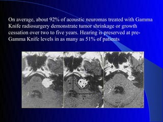 On average, about 92% of acoustic neuromas treated with Gamma
Knife radiosurgery demonstrate tumor shrinkage or growth
cessation over two to five years. Hearing is preserved at pre-
Gamma Knife levels in as many as 51% of patients
 
