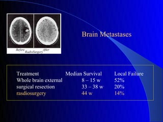 Brain Metastases




Treatment            Median Survival   Local Failure
Whole brain external       8 – 15 w    52%
surgical resection         33 – 38 w   20%
rasdiosurgery              44 w        14%
 