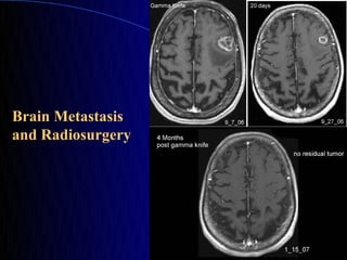 Brain Metastasis
and Radiosurgery
 