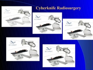 Cyberknife Radiosurgery
 