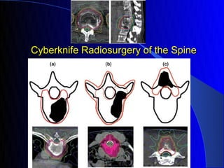 Cyberknife Radiosurgery of the Spine
 