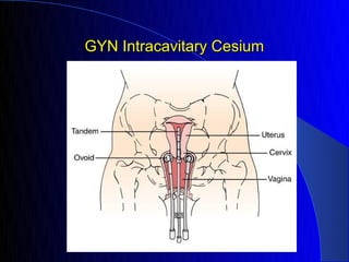 GYN Intracavitary Cesium
 