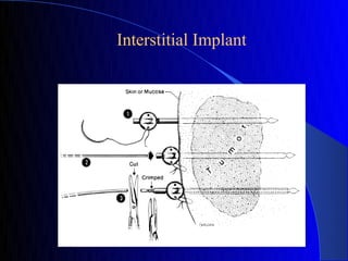 Interstitial Implant
 