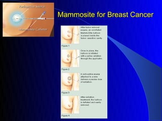 Mammosite for Breast Cancer
 