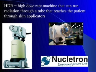 HDR = high dose rate machine that can run
radiation through a tube that reaches the patient
through skin applicators
 