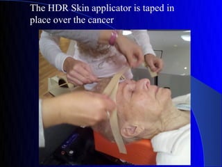 The HDR Skin applicator is taped in
place over the cancer
 