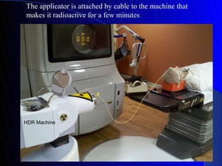 The applicator is attached by cable to the machine that
makes it radioactive for a few minutes
 
