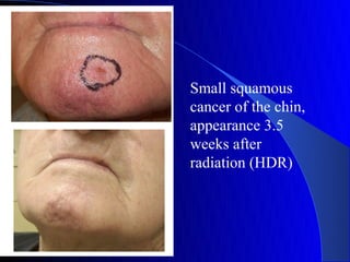 Small squamous
cancer of the chin,
appearance 3.5
weeks after
radiation (HDR)
 