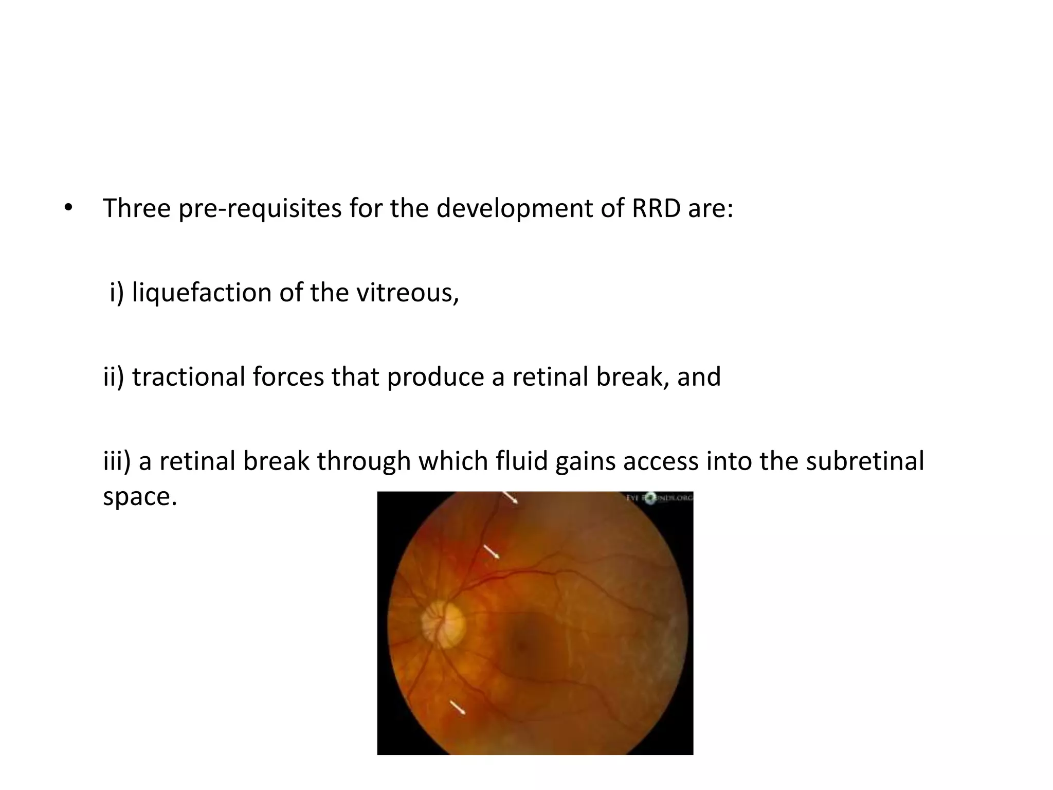 Evolution of retinal detachment surgery | PPT