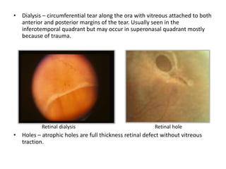 Retinal Repair Radiopaedia Retinal Dialysis