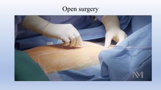 Open surgery
 
