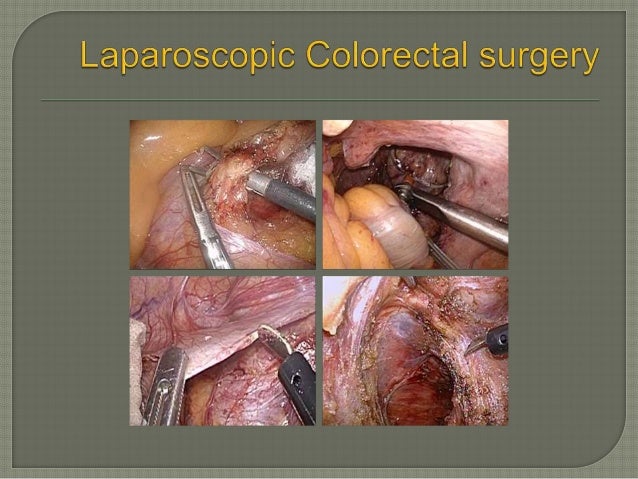 Evolution Of Surgery In Colorectal Cancer