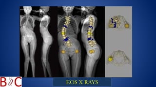 Evolution of surgical strategies instrumentation in scoliosis- dr ...