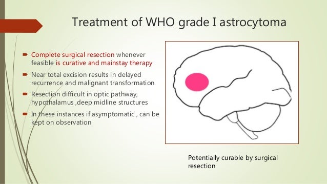 How To Know If You Have A Brain Tumor Brain Tumor Cancer
