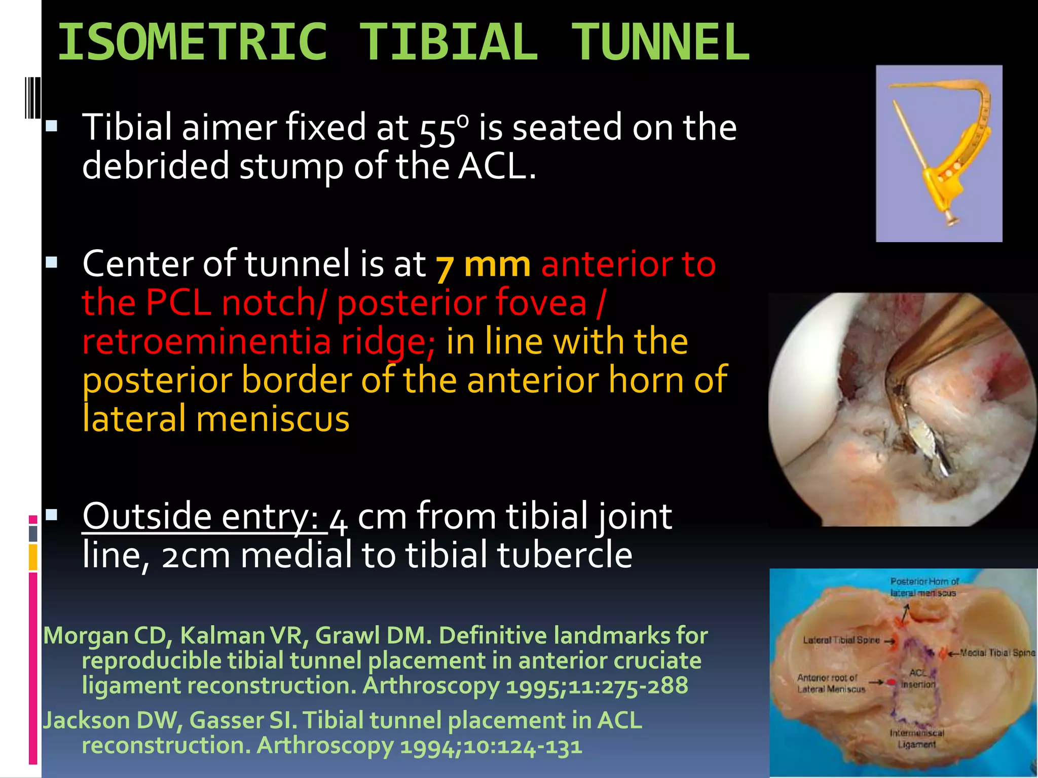 Evolution of tunnel placement in ACL reconstruction | PPTX