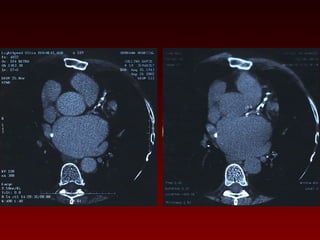 121 non invasive imaging of coronary arteries | PPT