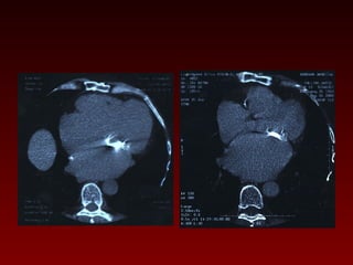 121 non invasive imaging of coronary arteries | PPT